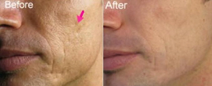 collagen_induction04