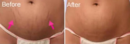 collagen_induction05